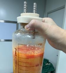 启东水动力吸脂手术要做多久？